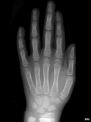 64866272-c0034588-normal-pediatric-hand-x-ray-spl.jpg