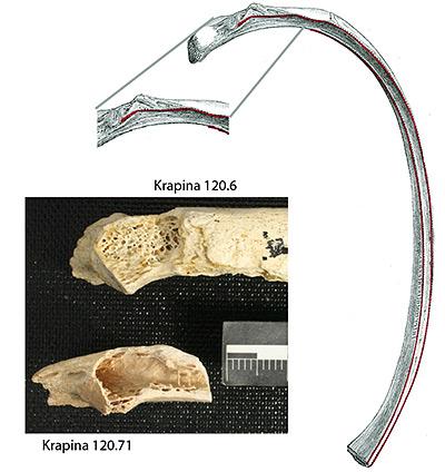 bonetumor-plostumormongefrayercomp1-400.jpg