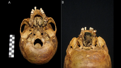 Gold prosthesis