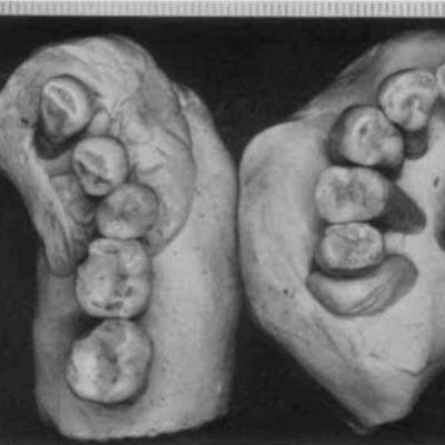 Krapina n individual teeth refitted wolpoff 1979