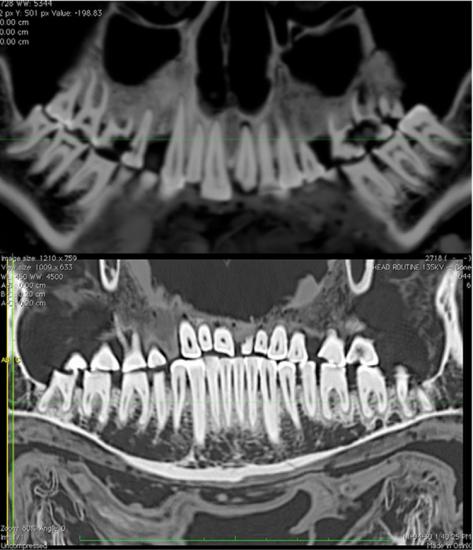 mummy-dental-filling-3.jpg