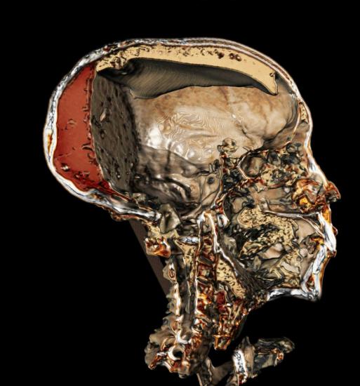 Scanning the pharaohs tut skull showing resin 956x1024