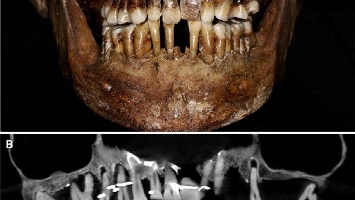 The teeth of 17th cent 2